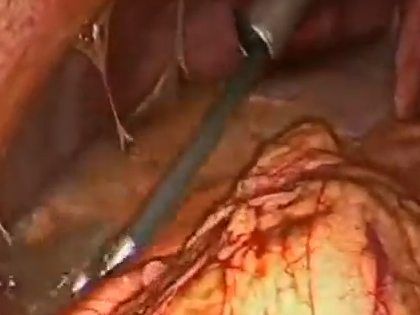 Laparoscopic Surgery in Mumbai